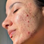 Useful Tips To Get Rid Of Acne